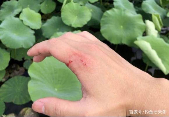 浙江男子野外钓鱼时被不明大鱼咬伤，网友：大意了！没有闪